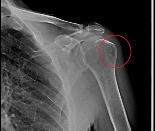 Рентгенодиагностика артроза плечевого сустава