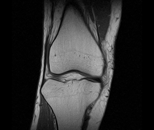 Дистрофические изменения заднего рога. Повреждение мениска коленного сустава рентген. Снимок мрт коленного сустава с разрывом мениска. Разрыв медиального мениска коленного сустава рентген.