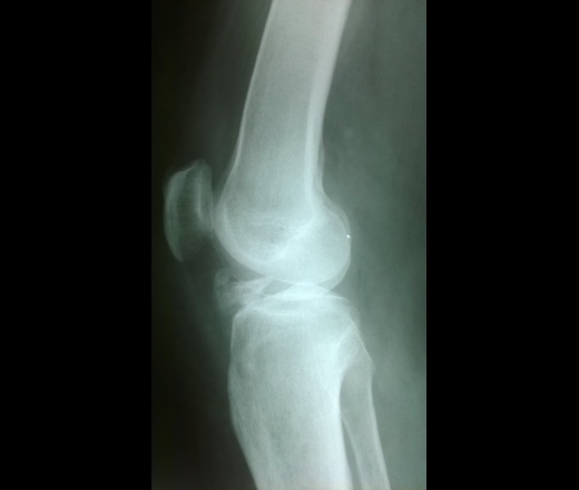 Рентгенография коленных суставов (в одной проекции) - Клиника ЕВРОМЕД