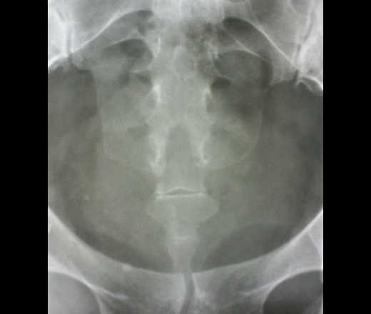 Подготовка к рентгенографии пояснично-крестцового отдела позвоночника и костей таза