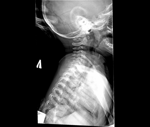 Снимок шейного отдела позвоночника. Шейный отдел позвоночника у новорожденных рентген. Шейный отдел позвоночника новорожденного на рентгене. Рентген шейных позвонков ребенку. Шейный отдел позвоночника у детей на рентгене.