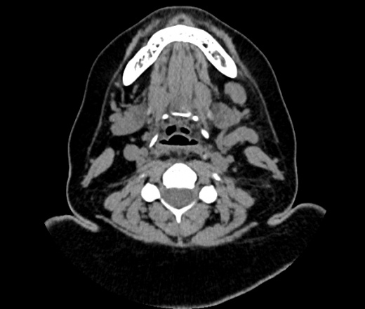 Кт шеи. Лимфогранулематоз кт ОГК. Эмфизема мягких тканей шеи кт.