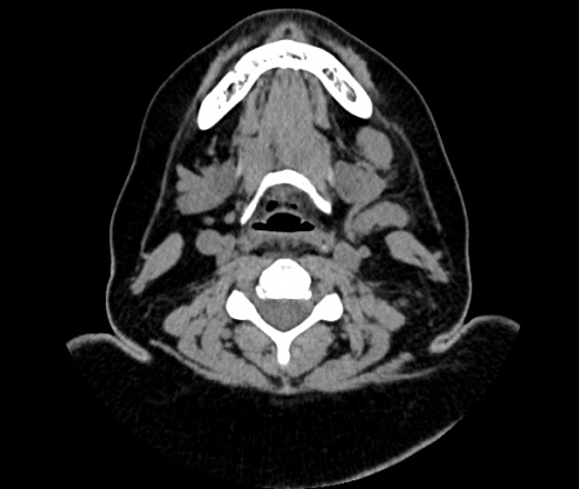 Кт шеи. Лимфоузлы шеи кт анатомия. Лимфогранулематоз кт ОГК. Группы лимфоузлов шеи на кт.