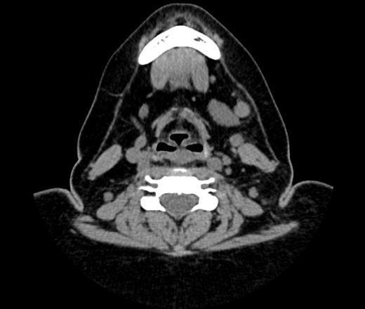 Кт шеи. Мягкие ткани шеи кт анатомия. Кт анатомия головы и шеи. Лимфогранулематоз у детей МСКТ.