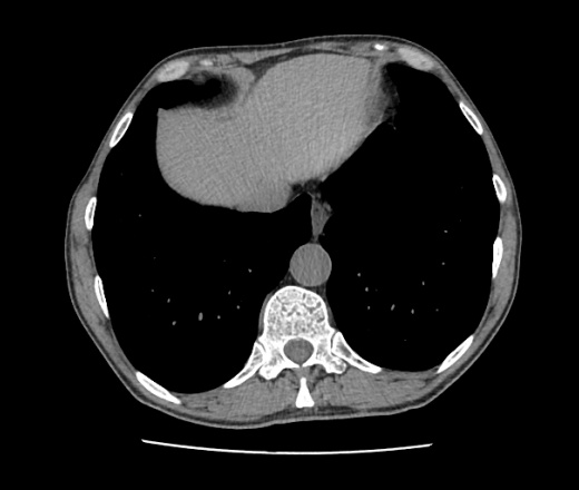 Кт органов грудной клетки