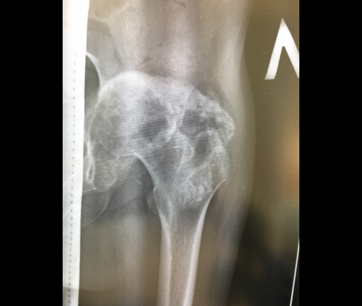 Рентгенография тазобедренного сустава (в 2 проекциях)