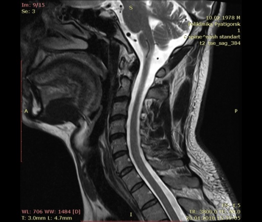 Мрт Шейного Отдела Позвоночника Цена Спб