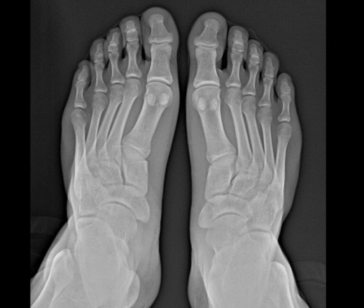Лечение вальгусной деформации первого пальца стопы. Поперечное плоскостопие