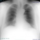 Диффузный пневмосклероз это рак. Пневмосклероз рентгенограмма. Пневмосклероз лёгких что на рентгене. Пневмосклероз легких рентген. Пневмофиброз легких рентген.