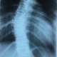 Рентгенография грудного отдела позвоночника на сколиоз