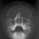 Рентген перелом скуловой кости