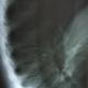 Кифосколиоз грудного отдела позвоночника рентген