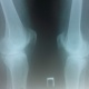Хондромное тело в коленном суставе рентген thumbnail