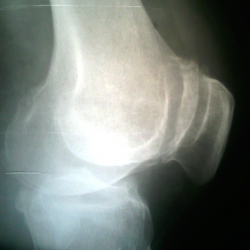 Что такое рентгенологическое обследование коленного сустава?