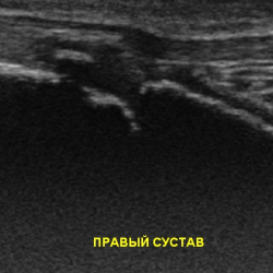 Межмыщелковые бугорки заострены что это. Смотреть фото Межмыщелковые бугорки заострены что это. Смотреть картинку Межмыщелковые бугорки заострены что это. Картинка про Межмыщелковые бугорки заострены что это. Фото Межмыщелковые бугорки заострены что это