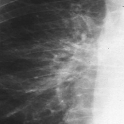 Рентгеновские снимки при обструктивном бронхите