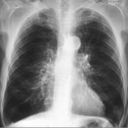 Рентген при бронхите - симптомы, расшифровка ренгенограммы thumbnail