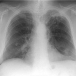 Бронхиты в рентгенологии 2. Параллельно ветке https://radiomed.ru/forum/41072-bronhity-v-rentgenologii?page=1#new