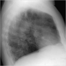 Пример описание рентгенограммы легких с бронхитом