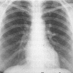 Рентген при бронхите - симптомы, расшифровка ренгенограммы