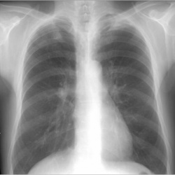 Примеры описание рентгенограммы при бронхите thumbnail
