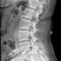 Рентген позвоночника поясничного. Рентген поясничного отдела позвоночника. Рентген здорового позвоночника сбоку. Поясничный отдел позвоночника рентген норма. Остеохондроз поясничного отдела позвоночника рентген.