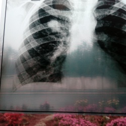 Рентген после пневмонии у детей thumbnail