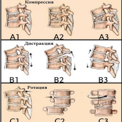 Классификация переломов позвоночника denis