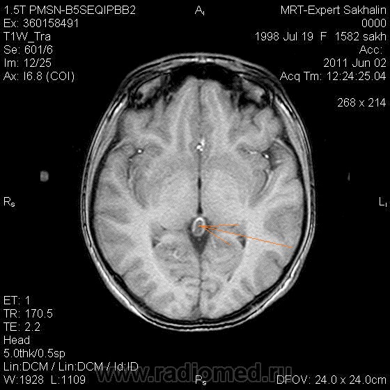 Мрт головного мозга киста шишковидной железы. Киста эпифиза в головном мозге на мрт. Шишковидная железа мрт. Шишковидная железа на мрт в норме.