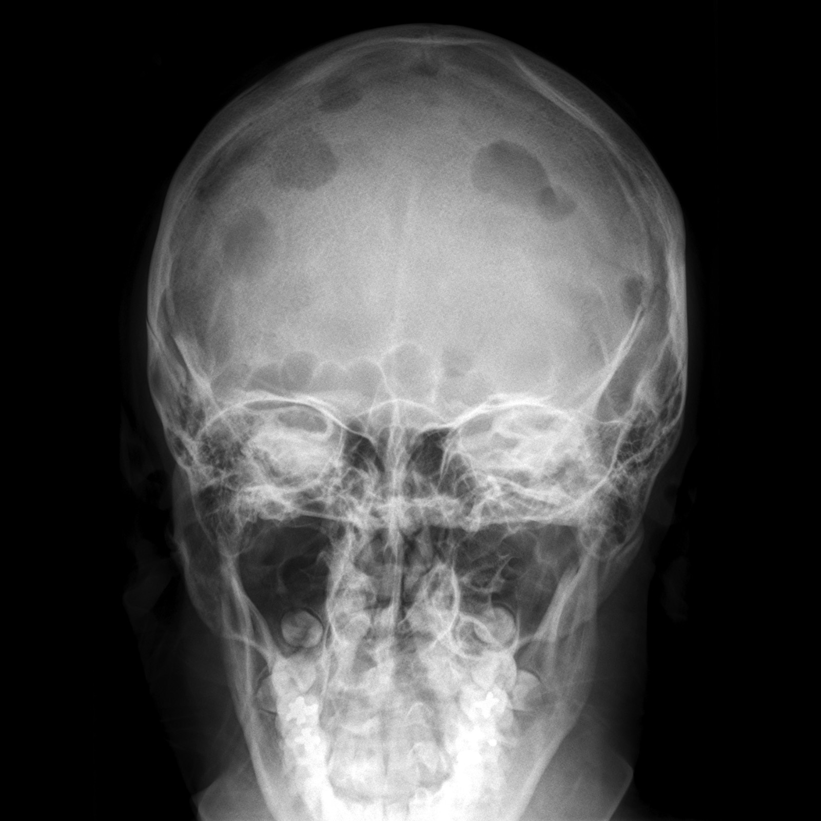 Кости черепа рентген