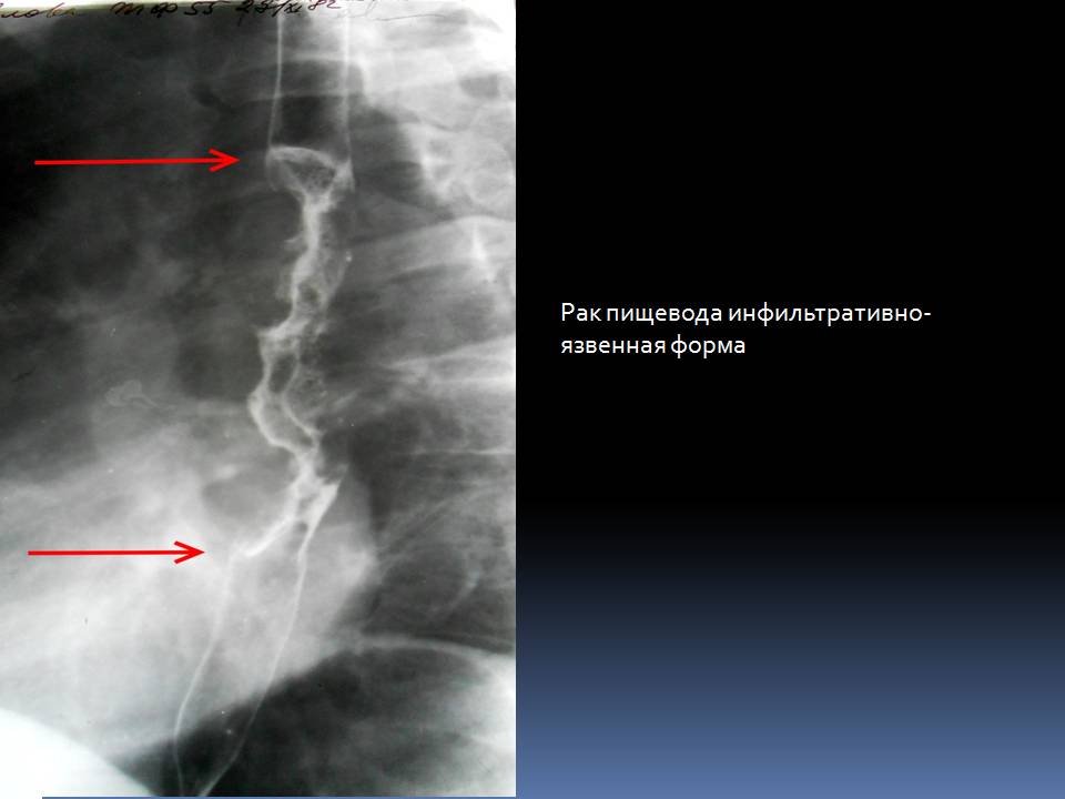 Формы рака пищевода