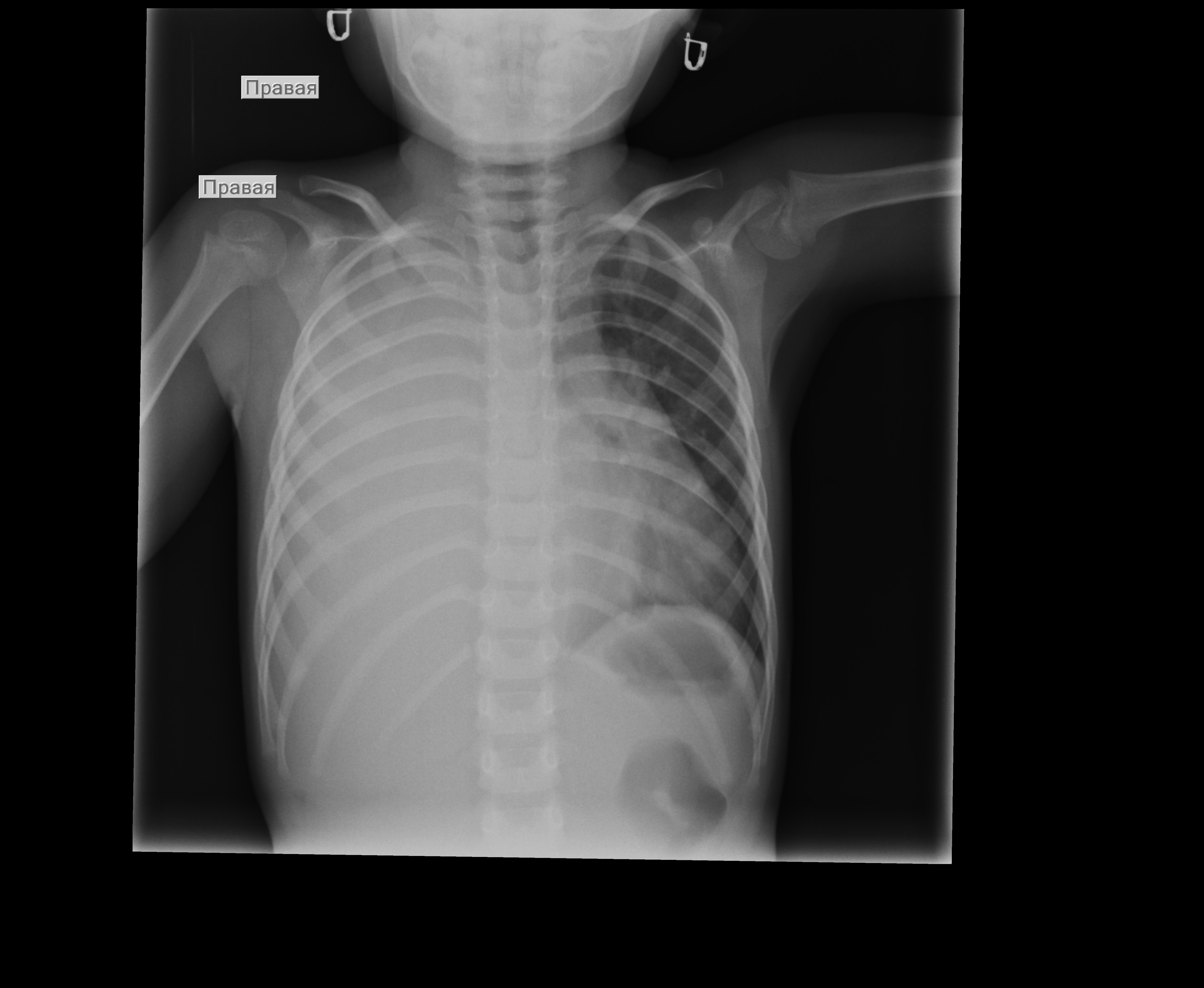 Делают рентген грудной клетки ребенку. Рентген грудной клетки норма. Рентген органов грудной клетки. Рентген снимок грудной клетки. Рентгенограмма грудной клетки у детей.