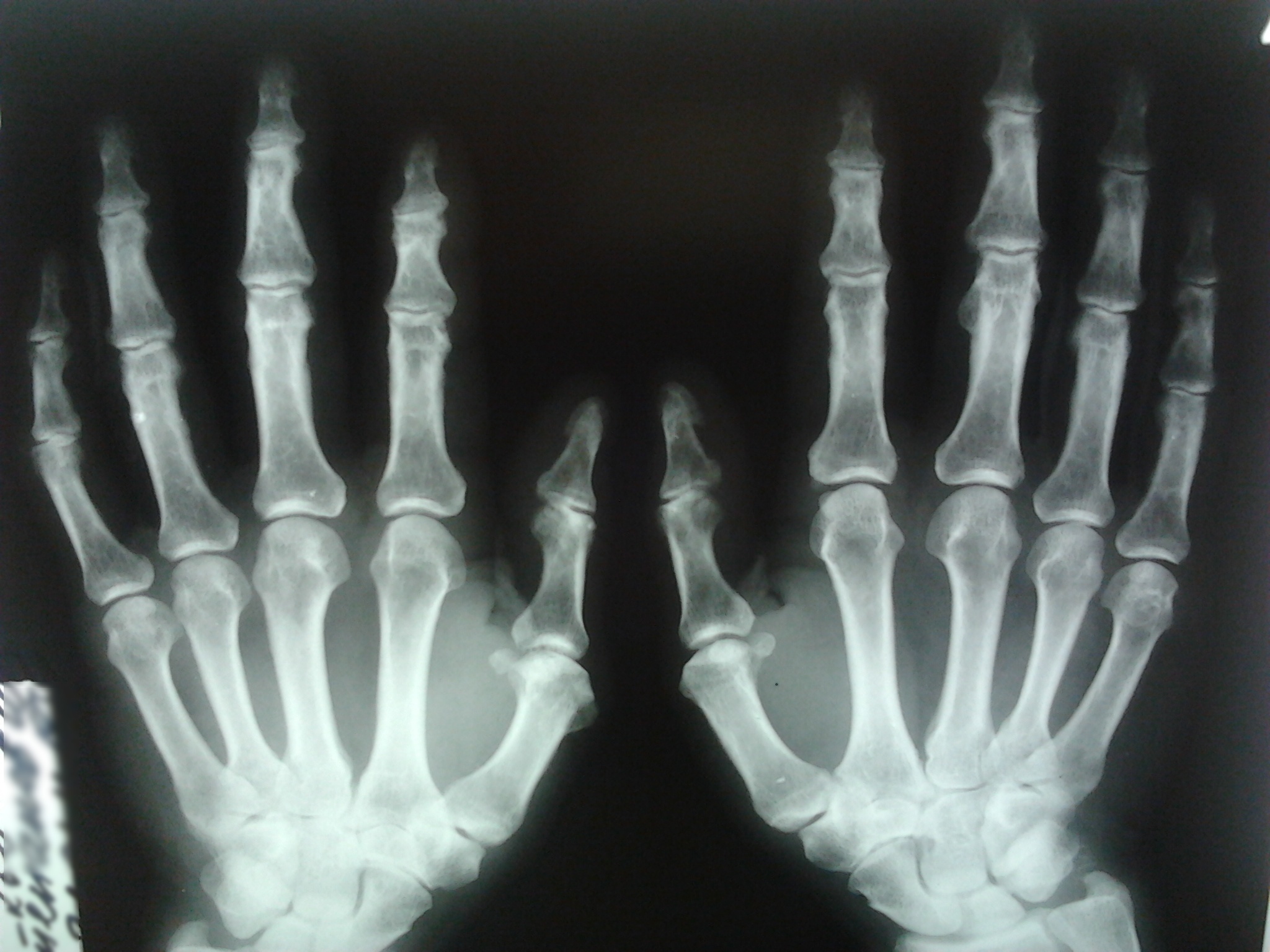 Остеоартроз 1 пястно фалангового сустава рентген