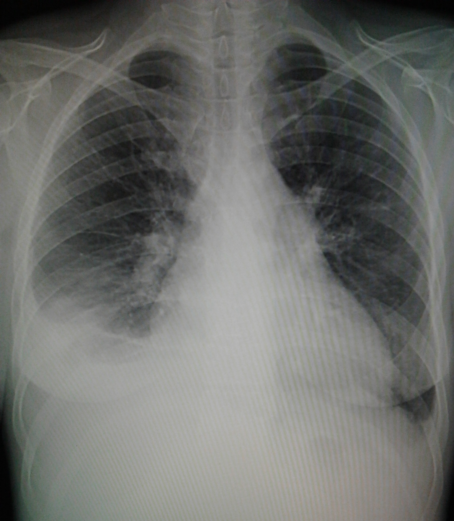 Пневмония в правом легком в нижней доле. Правосторонняя нижнедолевая пневмония рентген. Нижнедолевая пневмония рентген. Грудная клетки рентген пневмония нижнедолевая. Правосторонняя среднедолевая пневмония рентген.