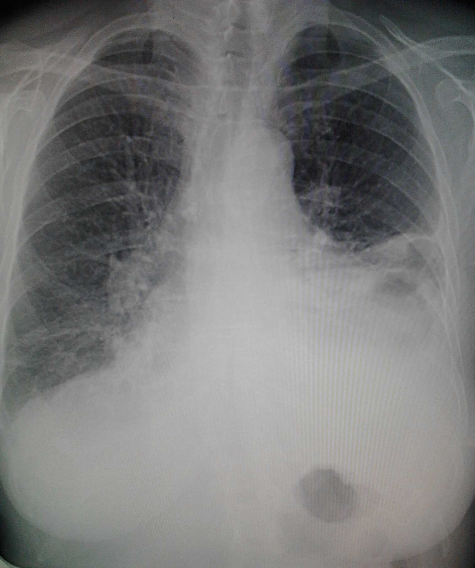 Воспаление легких на снимке рентгена фото