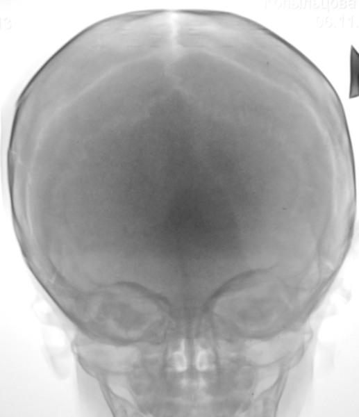 Трещина черепа у ребенка. Краниостеноз у детей рентген.