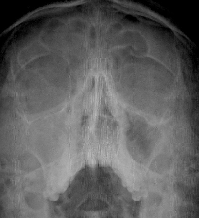 Рентгенография придаточных пазух носа. Рентген придаточных пазух носа фронтит. Левосторонний фронтит на рентгене. Катаральный синусит рентген.