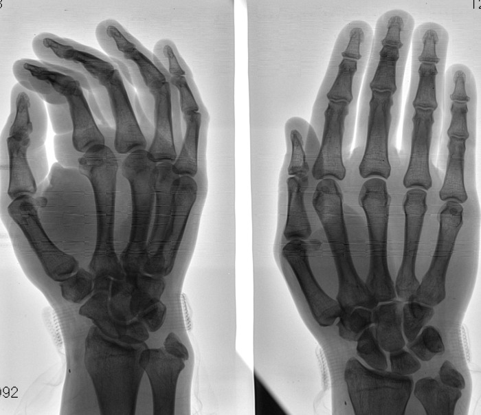Рентген кисти руки фото здоровой правой