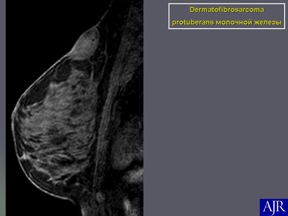 Рак молочной железы фото начальная стадия фото как выглядит как