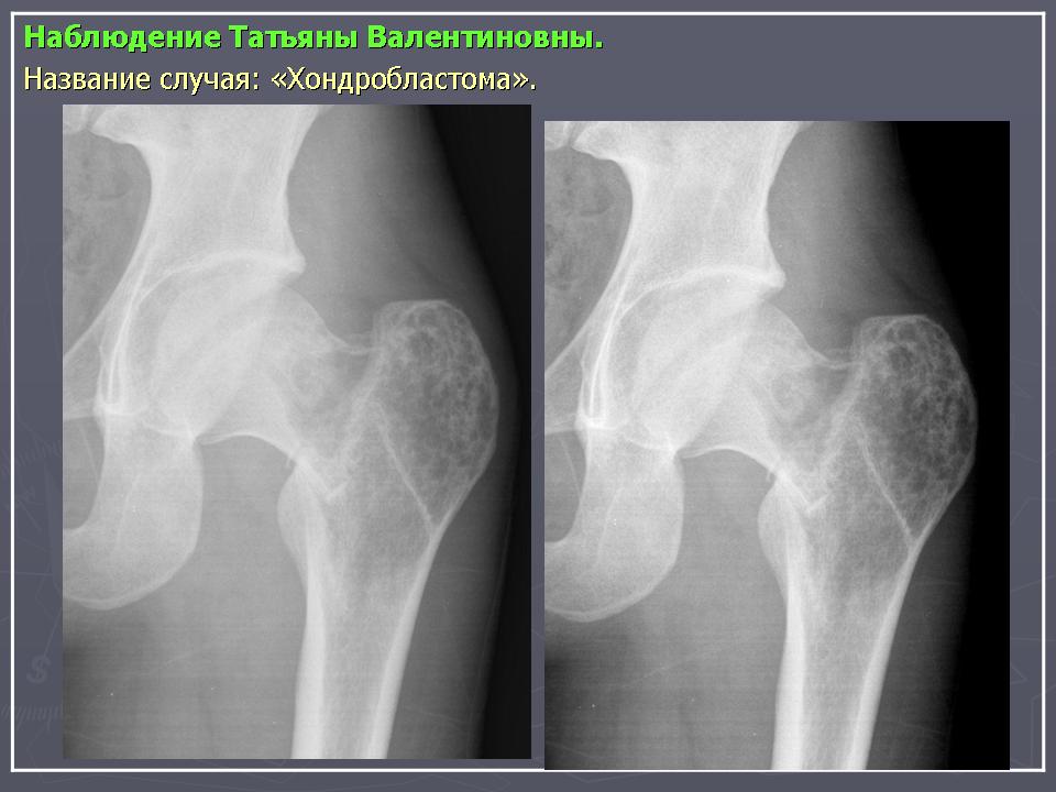 Опухоль из хрящевой ткани. Хондросаркома рентген бедренной. Саркома Юинга бедренной кости рентген. Остеосаркома тазобедренного сустава на рентгене. Остеогенная саркома бедренной кости рентген.