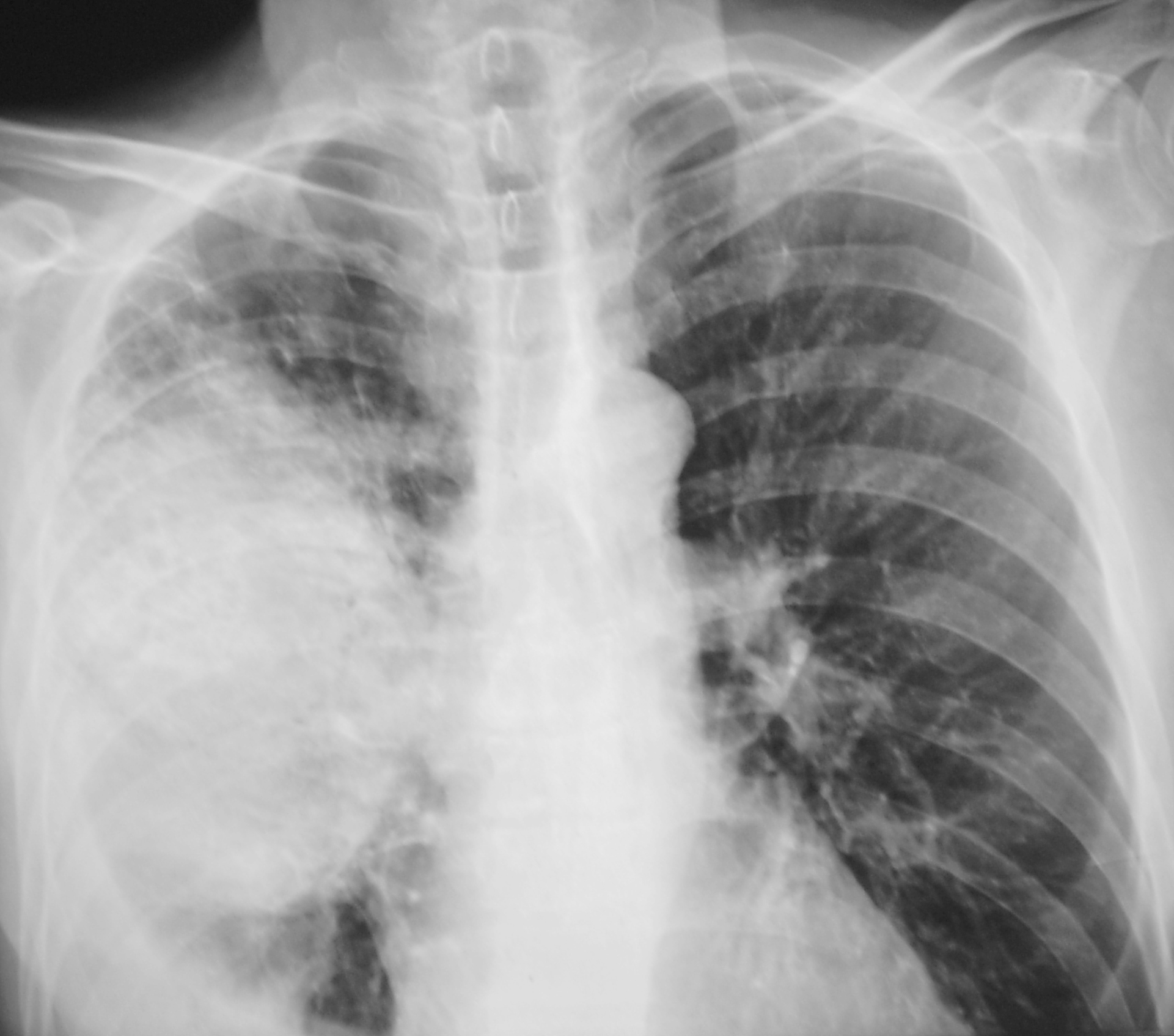 Вирусная пневмония рентгенологическая картина