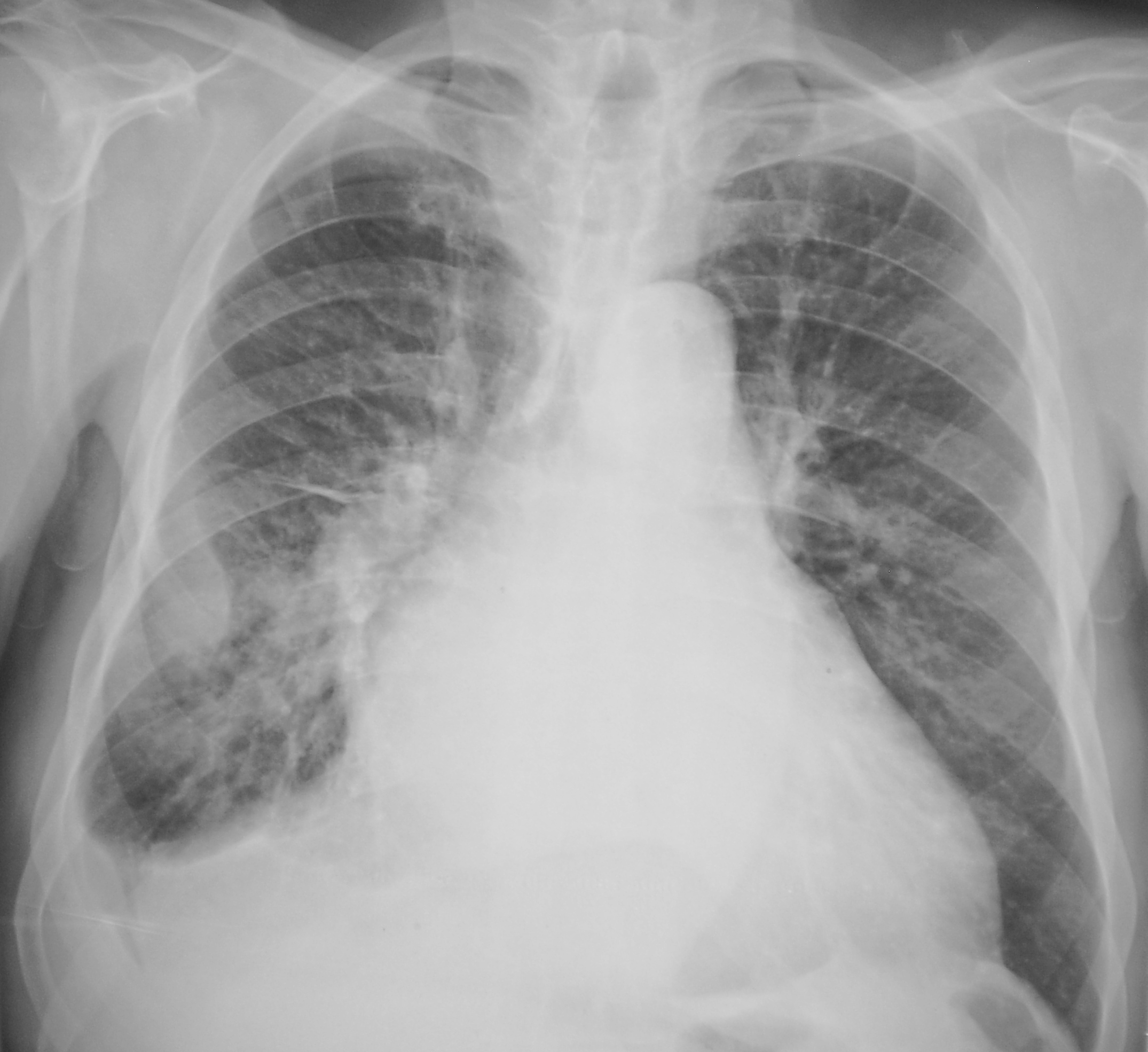 Флюшка. Pulmonary pleurae. COPD Chest Radiography. Chest x-rays of Patients with Pleural Effusion show.