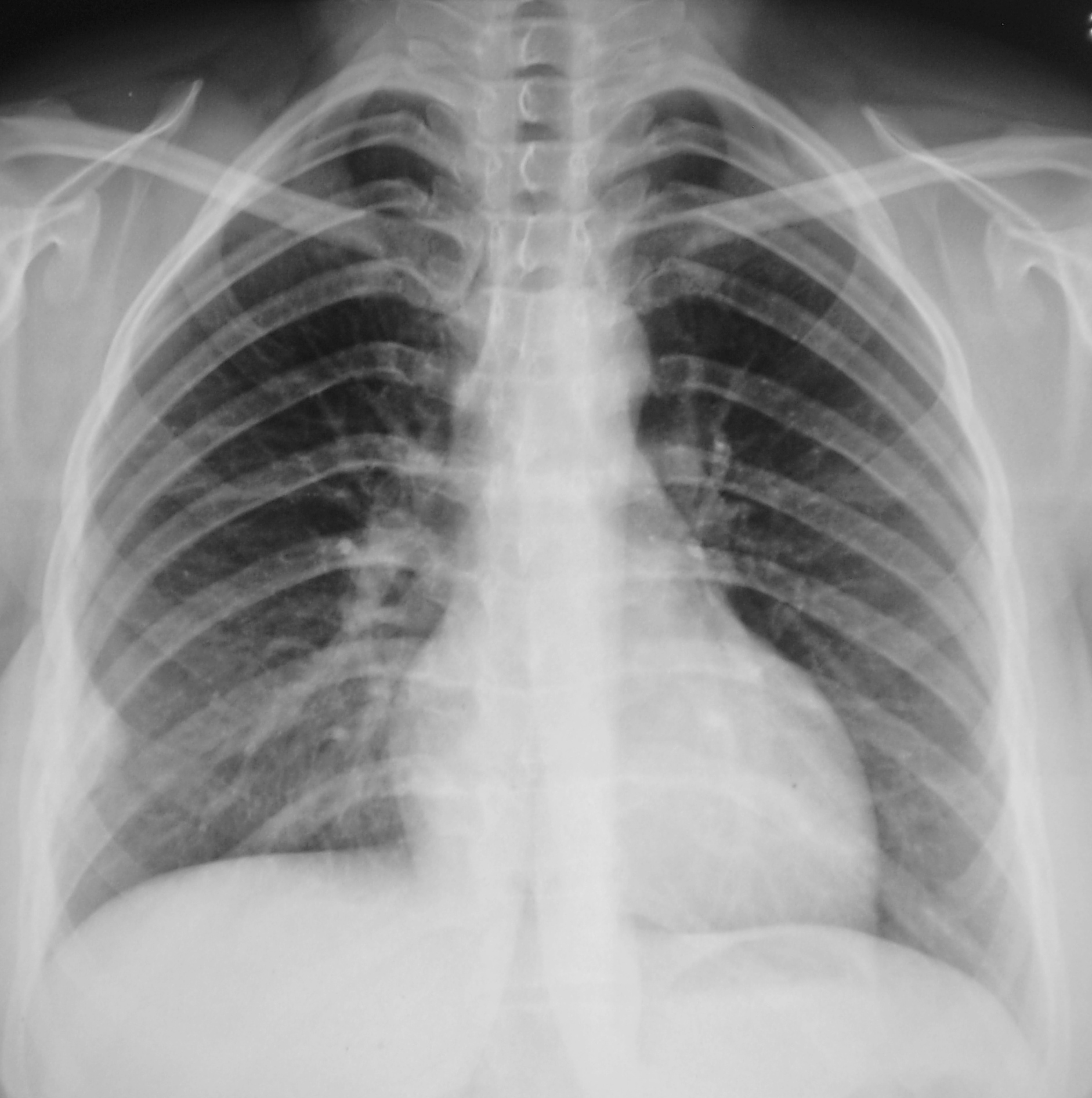 Пневмоцистная пневмония рентген