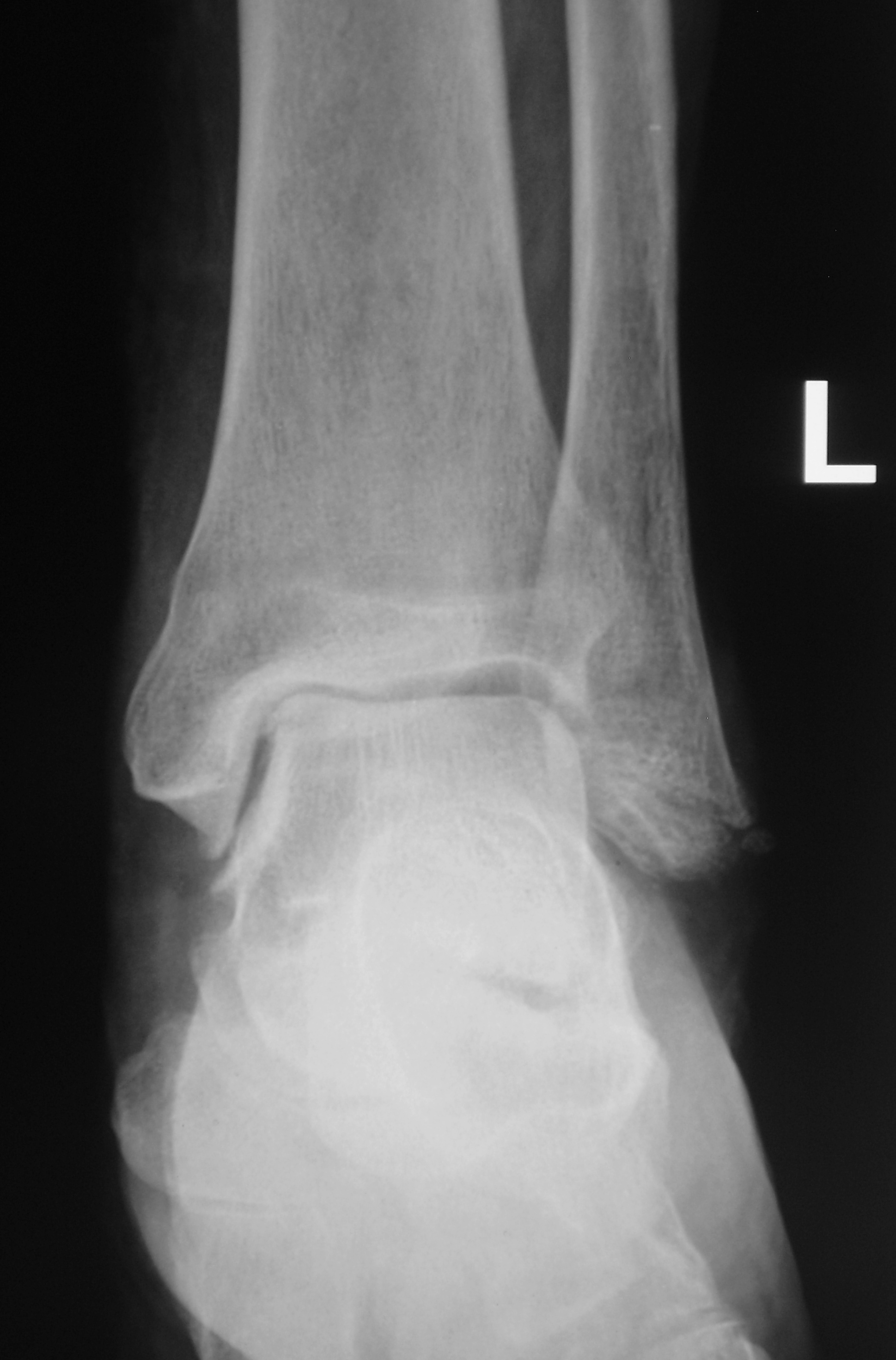 Голеностопный сустав левой ноги. Подвывих голеностопного сустава рентген. Перелом левого голеностопного сустава рентген. Рентген перелома лодыжки левой ноги. Перелом лодыжек левой голени рентген.
