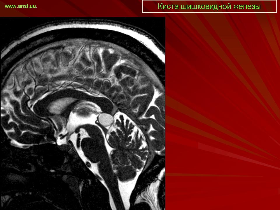 Мрт головного мозга киста шишковидной железы. Пинеалома опухоль шишковидной железы. Арахноидальная киста эпифиза. Мрт головного мозга эпифиз.