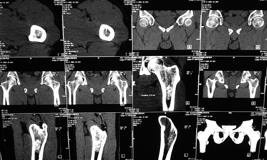 Сделать кт тазобедренного сустава. Энхондрома шейки бедренной кости кт. Остеопороз головки бедренной кости на кт. Кт нижней трети бедренной кости. Кт правой бедренной кости.