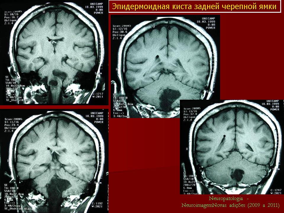Мр картина ретроцеребеллярной кисты