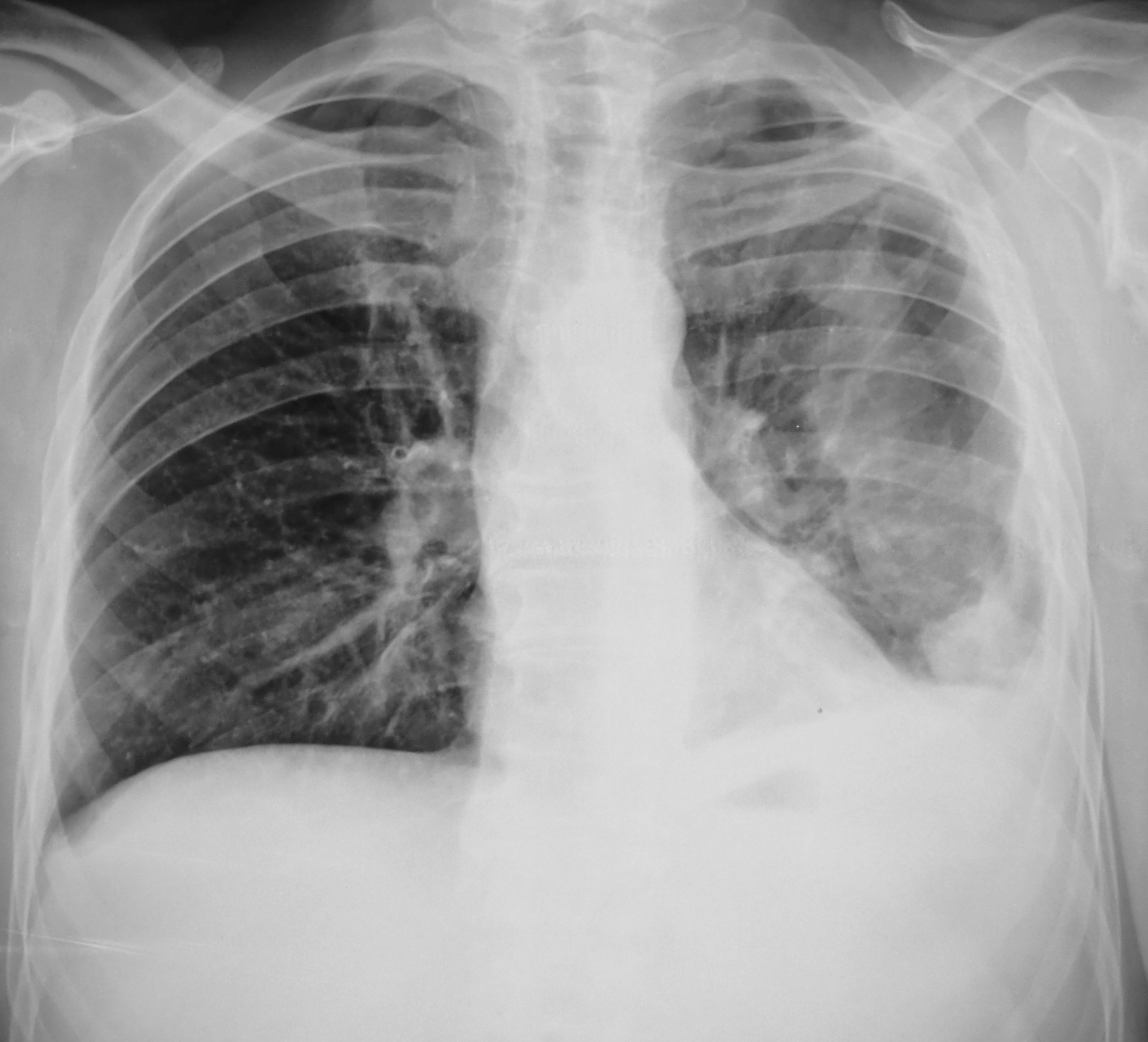 Левосторонняя нижнедолевая пневмония рентген