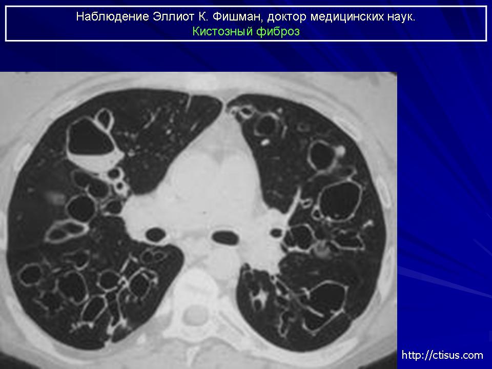 Кистозный фиброз фото