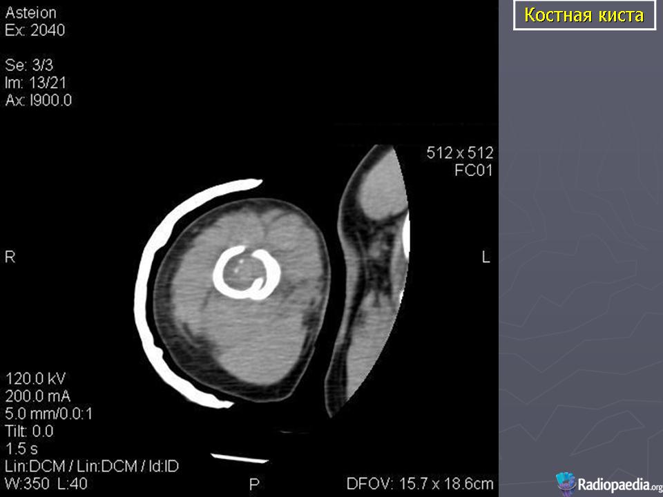 Киста костного мозга. Аневризмальная костная киста мрт. Солитарная костная киста на кт. Ювенильная костная киста кт.